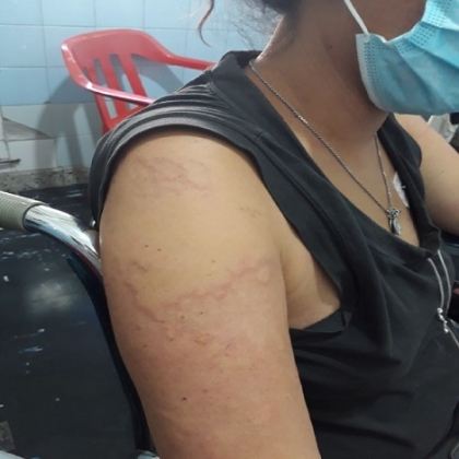 La doctora Martínez Albarracín denuncia que una mujer que se vacunó el miércoles sufre de fiebre, vómitos, diarrea y angioedema