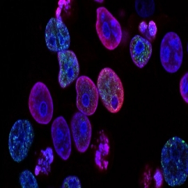 Un nuevo análisis de orina podría ser un método fácil para detectar el cáncer